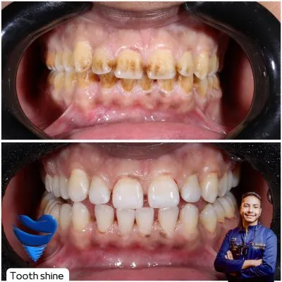 مركز أسنان شاين دكتور بشاي مينا اخصائي علاج و تجميل الاسنان