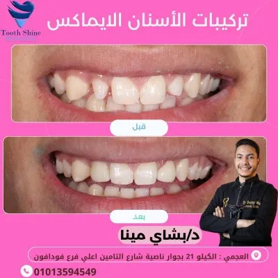 مركز أسنان شاين دكتور بشاي مينا اخصائي علاج و تجميل الاسنان