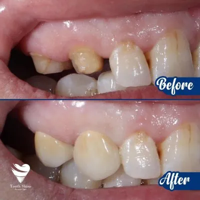 مركز أسنان شاين دكتور بشاي مينا اخصائي علاج و تجميل الاسنان