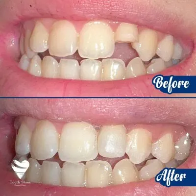 مركز أسنان شاين دكتور بشاي مينا اخصائي علاج و تجميل الاسنان