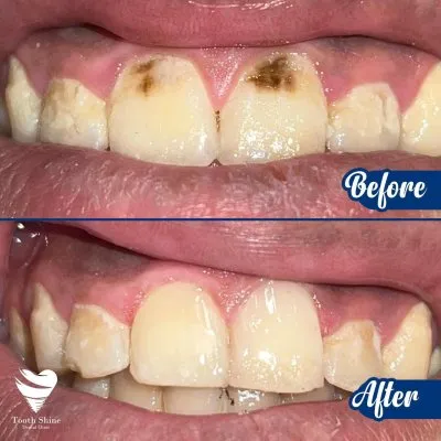 مركز أسنان شاين دكتور بشاي مينا اخصائي علاج و تجميل الاسنان