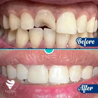مركز أسنان شاين دكتور بشاي مينا اخصائي علاج و تجميل الاسنان