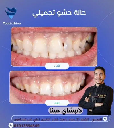 مركز أسنان شاين دكتور بشاي مينا اخصائي علاج و تجميل الاسنان