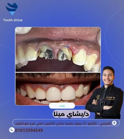 مركز أسنان شاين دكتور بشاي مينا اخصائي علاج و تجميل الاسنان