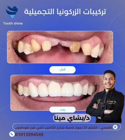 مركز أسنان شاين دكتور بشاي مينا اخصائي علاج و تجميل الاسنان