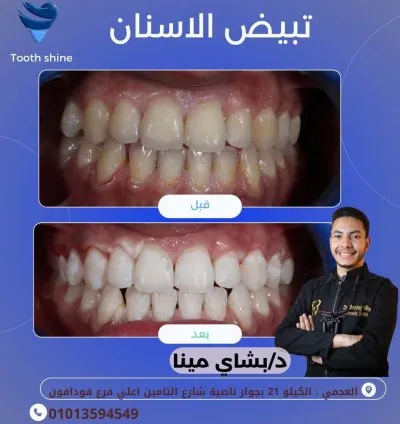 مركز أسنان شاين دكتور بشاي مينا اخصائي علاج و تجميل الاسنان