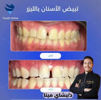 مركز أسنان شاين دكتور بشاي مينا اخصائي علاج و تجميل الاسنان
