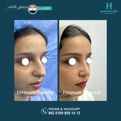 دكتور حسام ممدوح استشاري تجميل الانف
