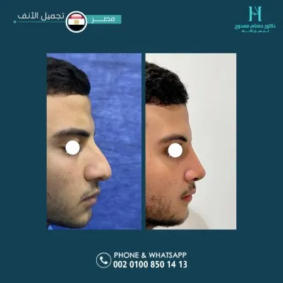 دكتور حسام ممدوح استشاري تجميل الانف