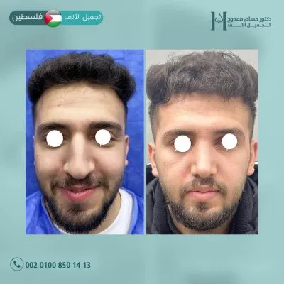 دكتور حسام ممدوح استشاري تجميل الانف