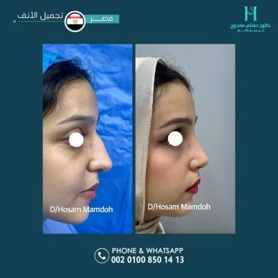 دكتور حسام ممدوح استشاري تجميل الانف