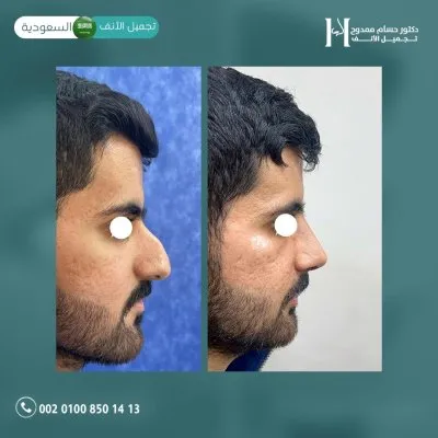 دكتور حسام ممدوح استشاري تجميل الانف