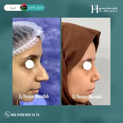 دكتور حسام ممدوح استشاري تجميل الانف