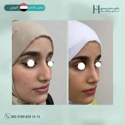 دكتور حسام ممدوح استشاري تجميل الانف