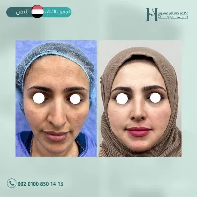 دكتور حسام ممدوح استشاري تجميل الانف