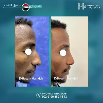 دكتور حسام ممدوح استشاري تجميل الانف