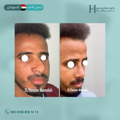 دكتور حسام ممدوح استشاري تجميل الانف