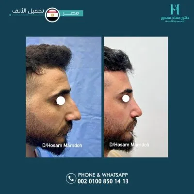دكتور حسام ممدوح استشاري تجميل الانف