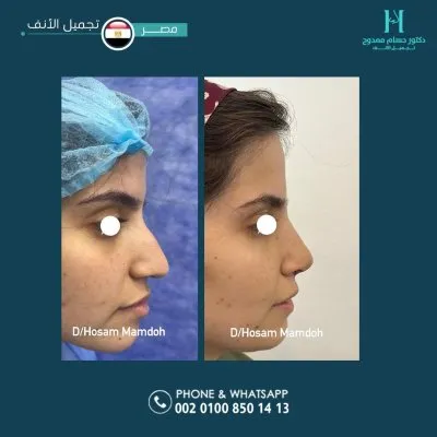دكتور حسام ممدوح استشاري تجميل الانف