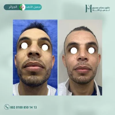 دكتور حسام ممدوح استشاري تجميل الانف