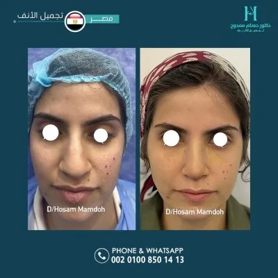 دكتور حسام ممدوح استشاري تجميل الانف