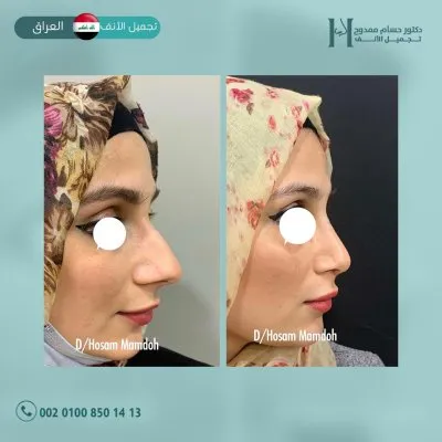 دكتور حسام ممدوح استشاري تجميل الانف