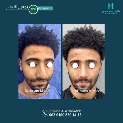 دكتور حسام ممدوح استشاري تجميل الانف