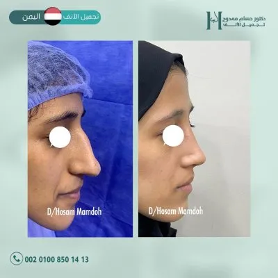 دكتور حسام ممدوح استشاري تجميل الانف