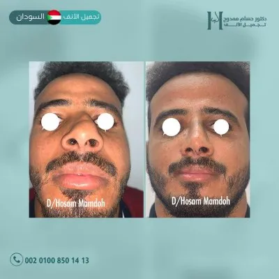 دكتور حسام ممدوح استشاري تجميل الانف