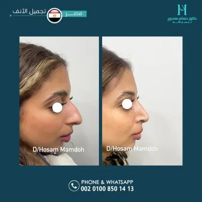 دكتور حسام ممدوح استشاري تجميل الانف