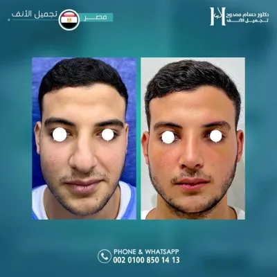 دكتور حسام ممدوح استشاري تجميل الانف