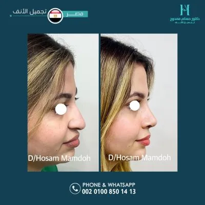 دكتور حسام ممدوح استشاري تجميل الانف