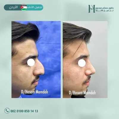 دكتور حسام ممدوح استشاري تجميل الانف