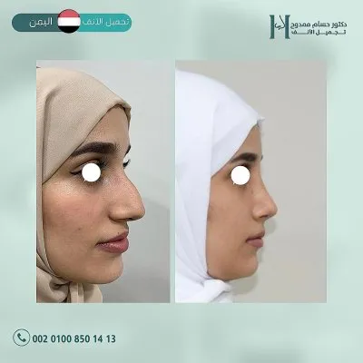 دكتور حسام ممدوح استشاري تجميل الانف