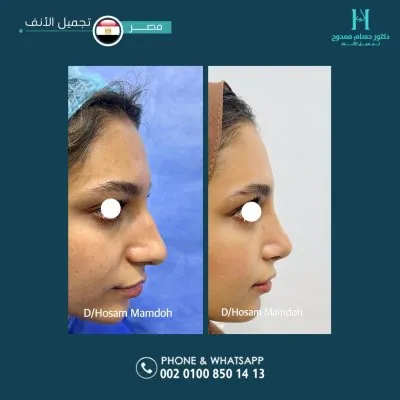 دكتور حسام ممدوح استشاري تجميل الانف