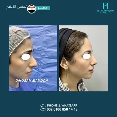 دكتور حسام ممدوح استشاري تجميل الانف