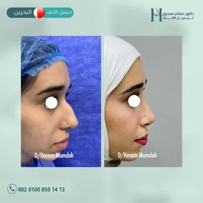 دكتور حسام ممدوح استشاري تجميل الانف