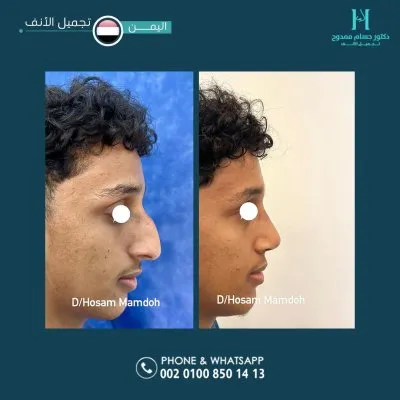دكتور حسام ممدوح استشاري تجميل الانف