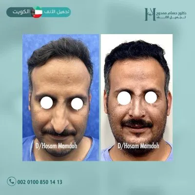 دكتور حسام ممدوح استشاري تجميل الانف