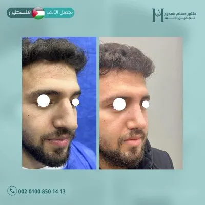 دكتور حسام ممدوح استشاري تجميل الانف