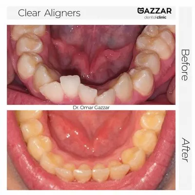 دكتور عمر الجزار أخصائى تقويم شفاف وتجميل أسنان