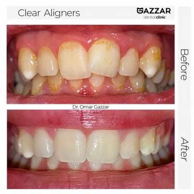 دكتور عمر الجزار أخصائى تقويم شفاف وتجميل أسنان
