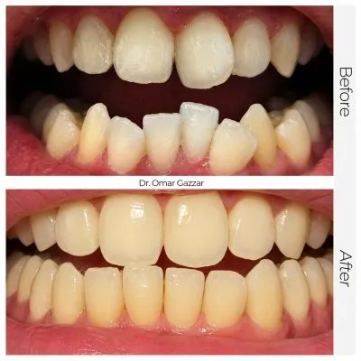 دكتور عمر الجزار أخصائى تقويم شفاف وتجميل أسنان