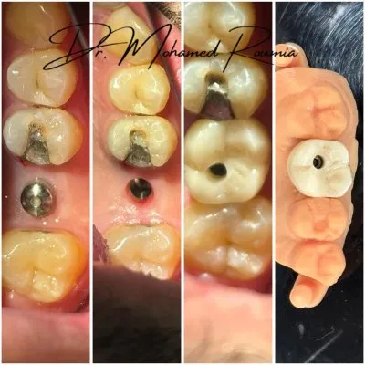دكتور محمد رومية أخصائي تجميل وزراعة الأسنان