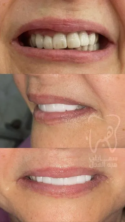 دكتورة هبة العدل مركز سمايلى للاسنان