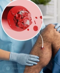 أعراض الجلطات الدموية انبوكس وطرق الوقاية منها؟