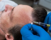 فوائد عملية زراعة الشعر وأنواعها كيفية إجراءها 