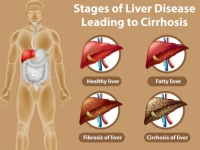 Symptoms and stages of kidney failure and methods of prevention and treatment