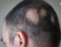 Causes of alopecia in men and women and methods of treatment
