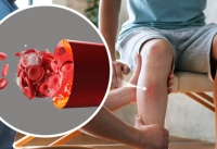 أعراض الجلطة الدموية والفئة المعرضة لها